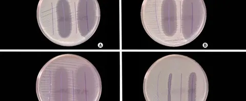 ANTIMICROBIAL SUTURES REDUCE INFECTIONS IN BRAIN SHUNT SURGERY